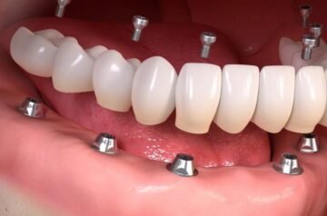 De Toekomst van Glimlachen: Alles over All-on-4 tandheelkundige implantaten