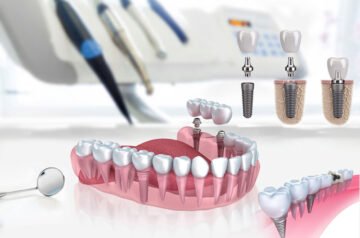 Comprendre le vrai coût des implants dentaires : qualité, prix et choix éclairés